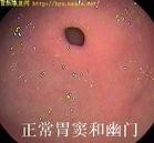 溃疡