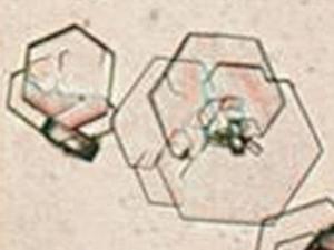 尿结晶