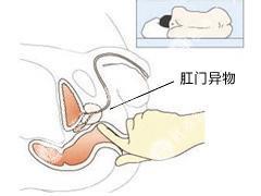 肛门异物感