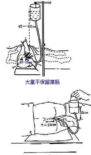 大量不保留灌肠