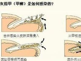灰指甲