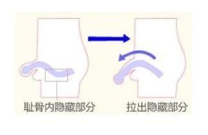 阴茎延长术