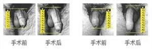阴茎延长术术后效果