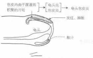 阴茎炎