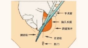 会阴侧切术