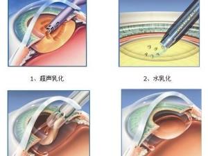 白内障手术