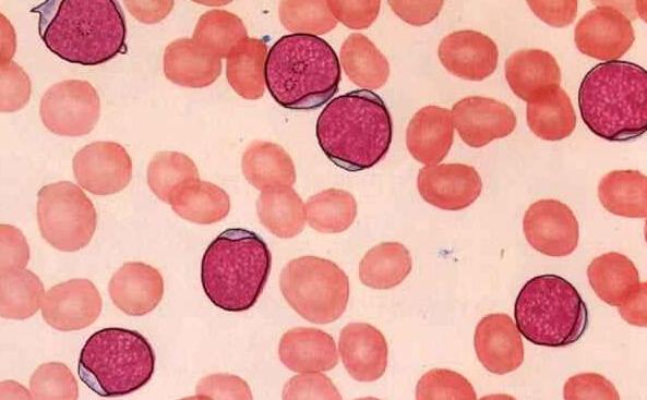 白血病细胞浸润