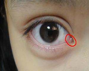 脂肪粒(3)脂肪粒,美容上的一个俗称,是一种长在皮肤上的米黄色颗粒,约