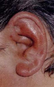 耳朵发炎的症状图片图片