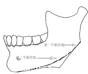 下颌角