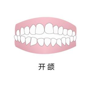 开颌