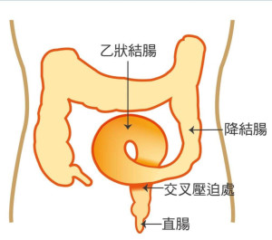 乙状结肠