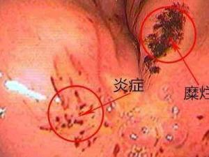 慢性浅表性胃炎