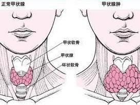 亚急性甲状腺炎