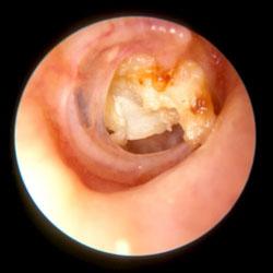 外耳道胆脂瘤图片图片