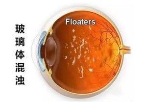 玻璃体炎