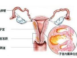 子宫内膜异位症