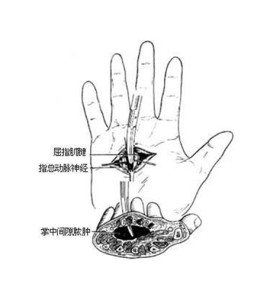 掌中间隙脓肿切开引流术