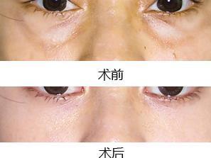 祛眼袋术