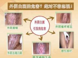 外阴白斑