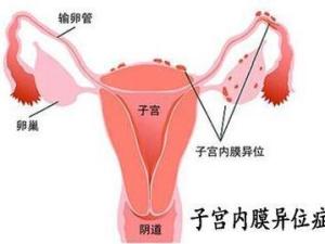 子宫内膜异位症
