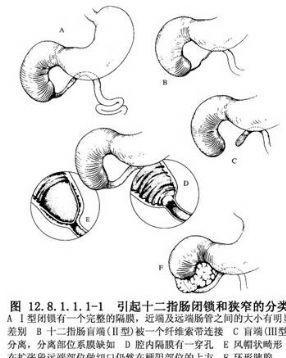 十二指腸十二指腸側側吻合術