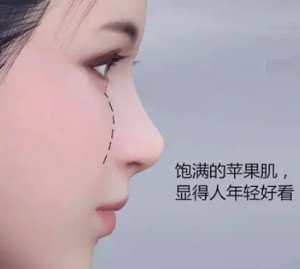 苹果肌