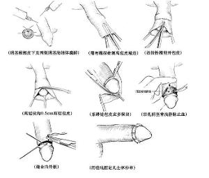 阴茎短小
