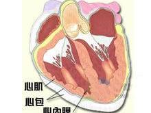 心包切开术后综合征