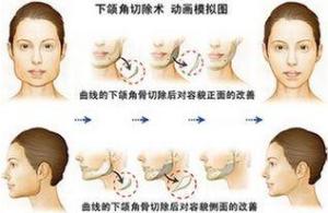 下颚角切除术