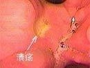溃疡