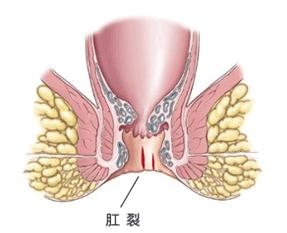 肛乳头肥大鉴别