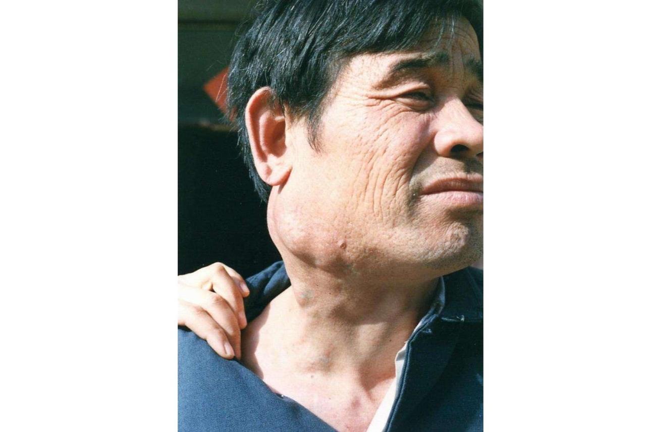 瘰疠_搜狗百科