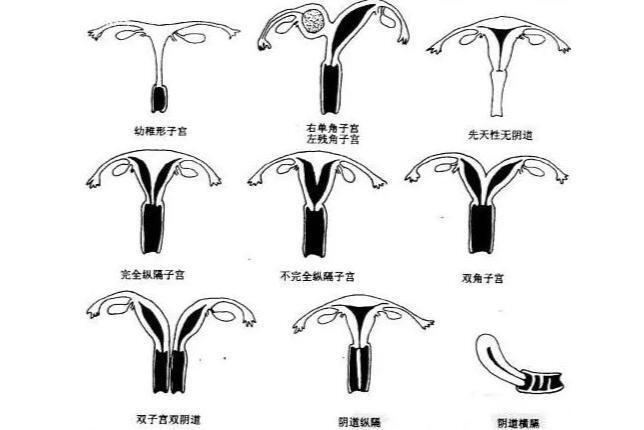 幼稚型子宫_搜狗百科