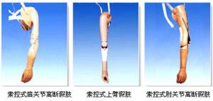 假肢