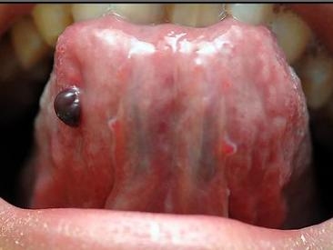 舌根有血泡图片图片
