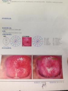 宫颈糜烂3度