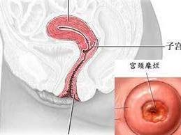 宫颈糜烂3度