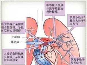 肺梗塞 搜狗百科