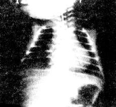 急性肺栓塞X光片