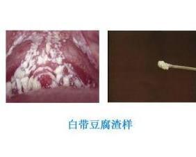 轻度霉菌感染是怎么引起的（轻度霉菌白带图片）