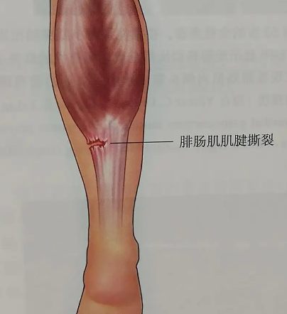 腓肠肌
