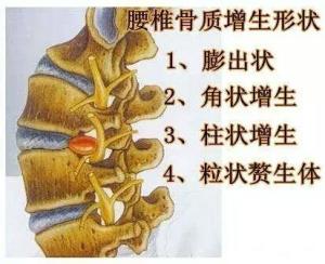 腰椎骨質增生