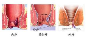 痔疮