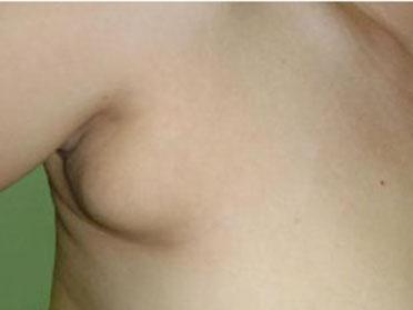 副乳 搜狗百科 副乳 搜狗百科