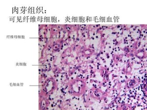 肉芽组织
