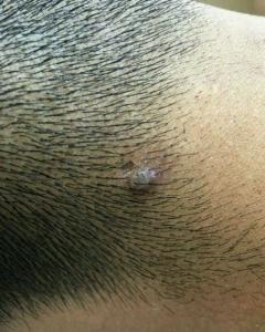 瘊子- 搜狗百科