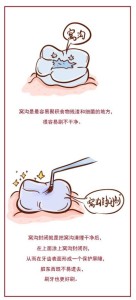 窝沟封闭
