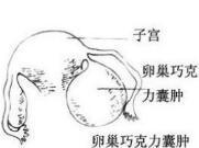 巧克力囊肿