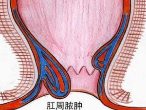 肛门脓肿
